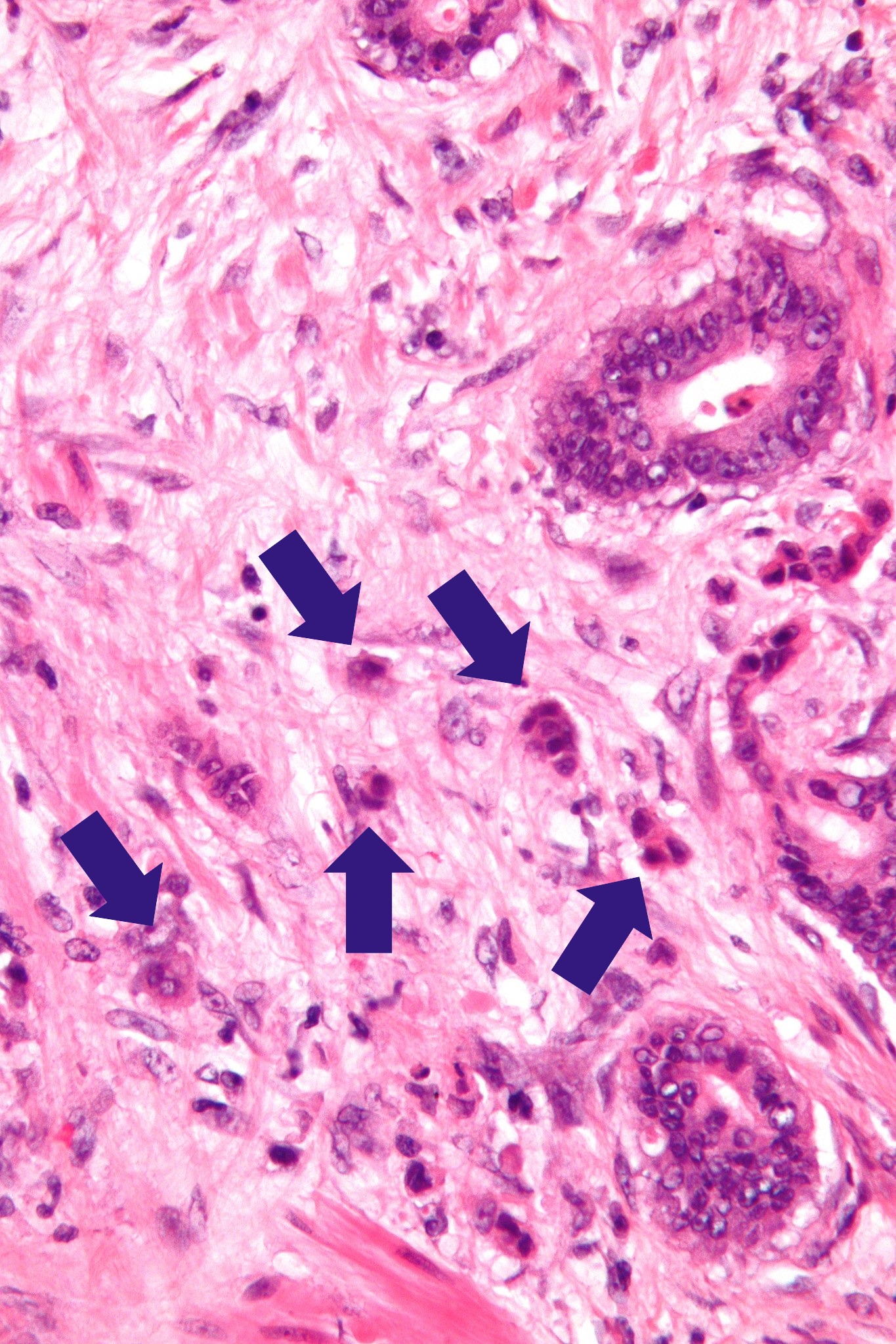 Tumor-Budding
Tumor-Budding beim Kolonkarzinom. Einzelne Buds sind beispielhaft eingezeichnet.